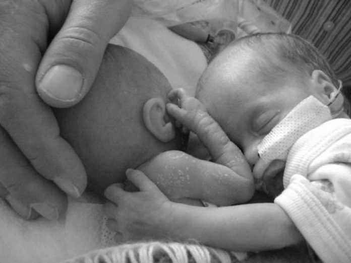 An Amazing Survival Story of a Premature Twin Baby